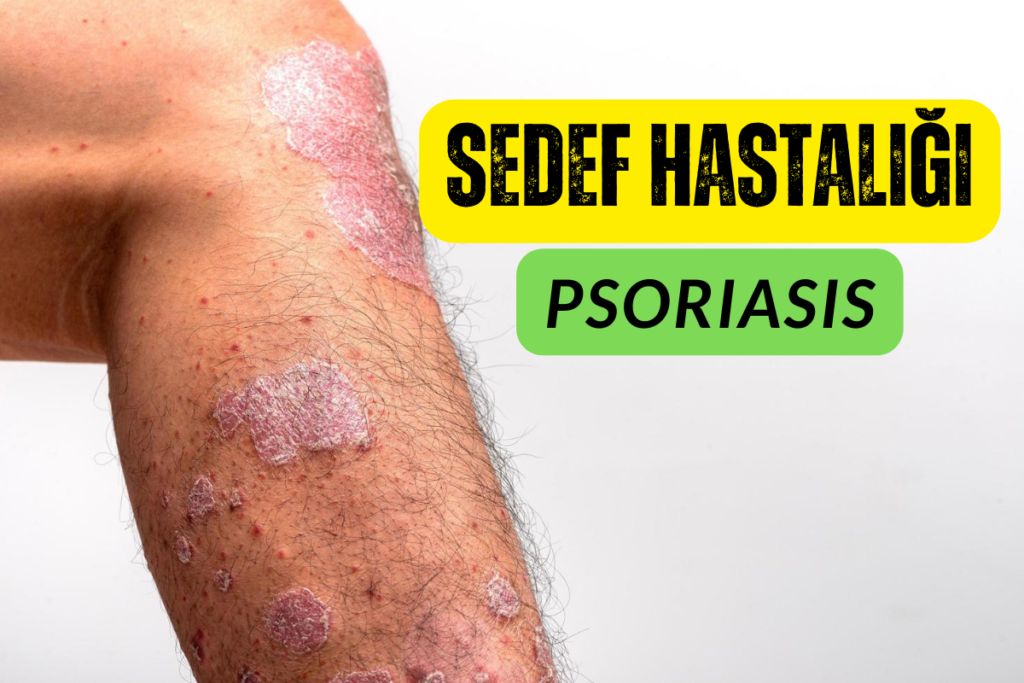 Sedef hastalığı psoriasis nedir 5 tipi ve belirtileri